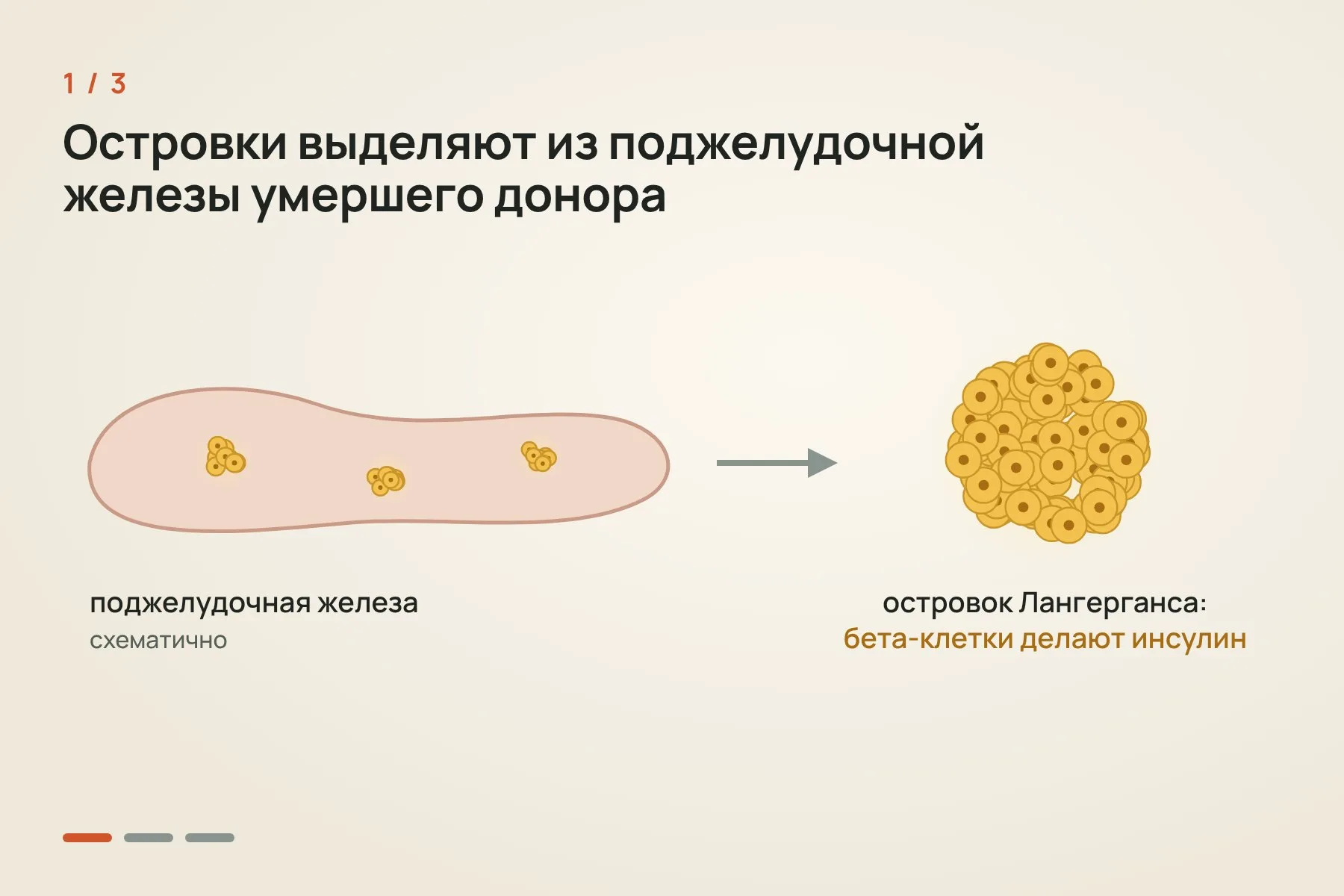 1. Островки Лангерганса выделяют из поджелудочной железы умершего донора · 2. Через катетер клетки вводят в печень · 3. Островки оседают в мелких сосудах печени и начинают вырабатывать инсулин. Иллюстрация: «Знай с Лобановым» — 1 из 3
