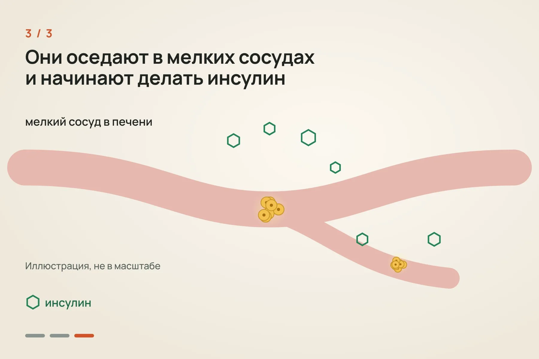 1. Островки Лангерганса выделяют из поджелудочной железы умершего донора · 2. Через катетер клетки вводят в печень · 3. Островки оседают в мелких сосудах печени и начинают вырабатывать инсулин. Иллюстрация: «Знай с Лобановым» — 3 из 3