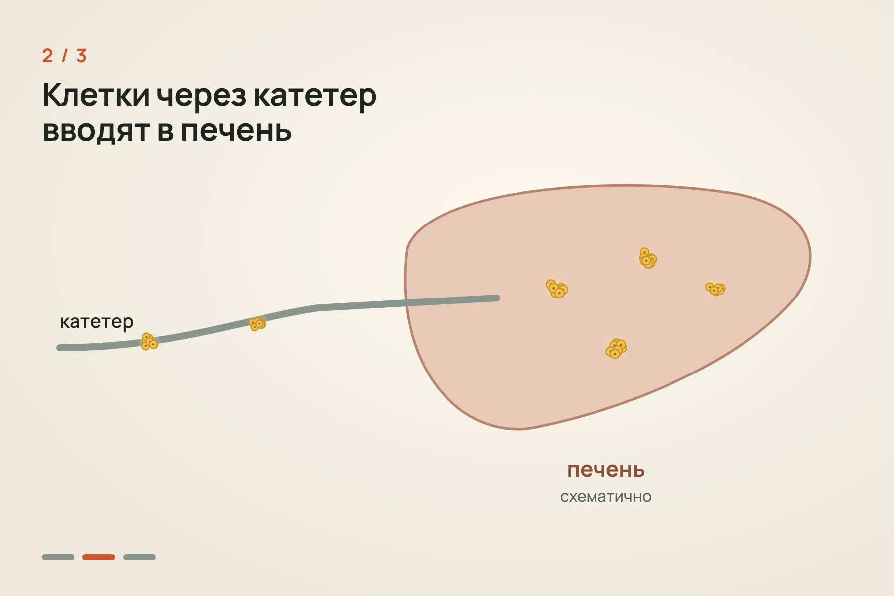 1. Островки Лангерганса выделяют из поджелудочной железы умершего донора · 2. Через катетер клетки вводят в печень · 3. Островки оседают в мелких сосудах печени и начинают вырабатывать инсулин. Иллюстрация: «Знай с Лобановым» — 2 из 3