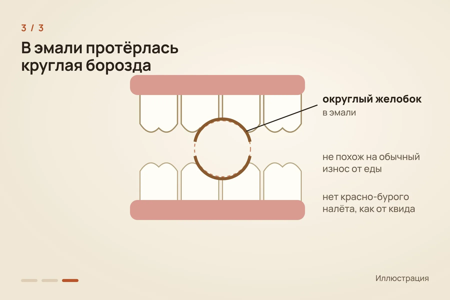 1. Твёрдое, почти круглое семя ареки диаметром 1–2 см лучше всего подходит под форму желобков · 2. Орех годами держали между зубами: перекатывали, посасывали и слегка покусывали · 3. За годы в эмали протёрся округлый желобок, непохожий на обычный износ от еды. Иллюстрация: «Знай с Лобановым» — 3 из 3